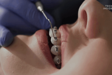 Cách niềng răng hoạt động phức tạp và thú vị hơn chúng ta nghĩ rất nhiều!