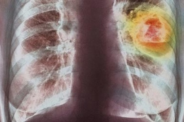 Thế giới: Tỉ lệ mắc ung thư tăng mạnh