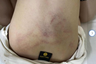 Vụ trẻ nghi bị giáo viên mầm non bạo hành: Công an vào cuộc xác minh