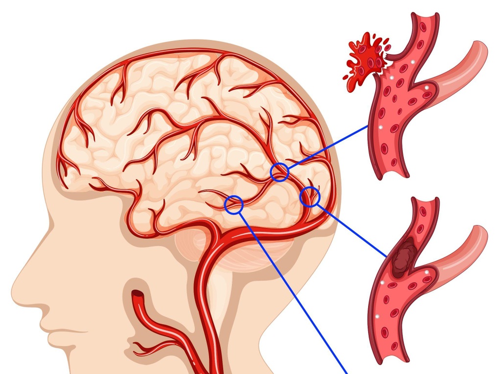 Tăng huyết áp - Thủ phạm chính gây đột quỵ não - 2