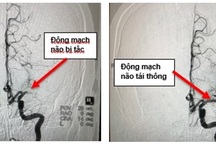 Cấp tốc vượt 150km đường biển và đường bộ kịp “giờ vàng” cấp cứu bệnh nhân đột quỵ