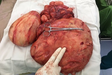 Người đàn ông mang “bầu giả” nặng hơn 7kg