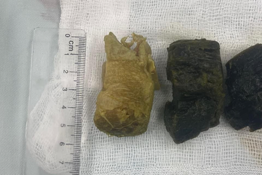 Ăn măng khô không biết điều này dễ rước bệnh vào người