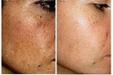 Bí quyết trị nám da hiệu quả sau 4 tuần