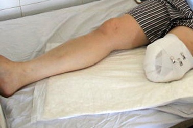 Rùng mình căn bệnh khiến con người tự chặt tay, chân trong vô thức