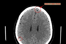 Sán làm tổ trong não vì món cá nhiều người Việt thích mê