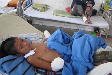 Dẫm phải mìn khi đi chăn bò, bé lớp 6 mất cả hai tay, dập nát hai chân