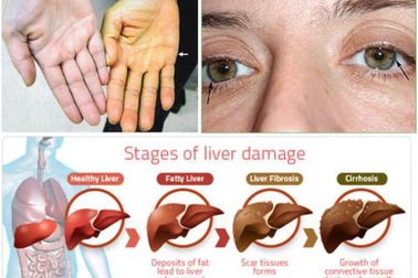 Bạn đang gặp vấn đề ở gan?