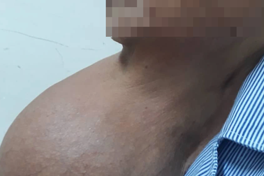 Người phụ nữ được giải thoát sau 20 năm dùng khăn, tay đỡ khối u treo lủng lẳng trước cổ