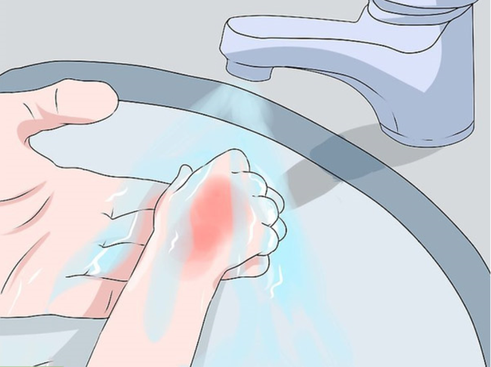 Hà Nội: Nhiều trẻ em bị bỏng nặng do sự bất cẩn của người lớn - 3 Hà Nội: Nhiều trẻ em bị bỏng nặng do sự bất cẩn của người lớn - 3