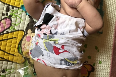 Bố mẹ nghèo, bé 3 tháng tuổi trên đảo Lý Sơn khốn khổ với hậu môn nhân tạo