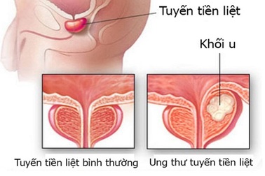 Tiên lượng bệnh ung thư tiền liệt tuyến