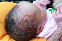 Bác sĩ làm rách đầu trẻ sơ sinh sau mổ đẻ, phải khâu 6 mũi