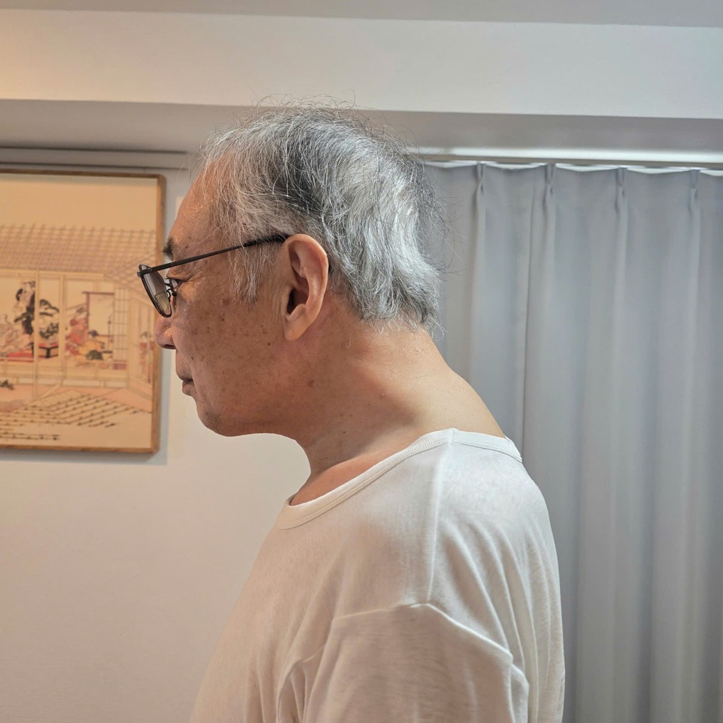 Giáo sư người Nhật mắc bệnh hiếm, sang Việt Nam điều trị thành công - 1 Giáo sư người Nhật mắc bệnh hiếm, sang Việt Nam điều trị thành công - 1