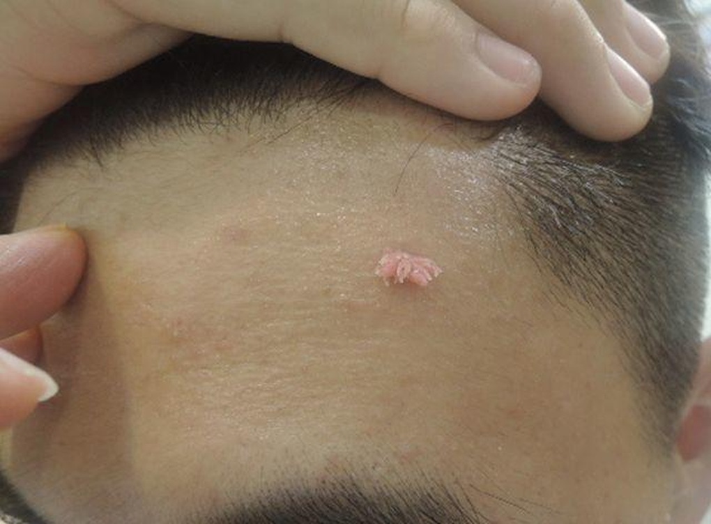 Bố mẹ tá hỏa khi biết con cấp một bị sùi mào gà: Bất ngờ với nguồn lây - 1 Bố mẹ tá hỏa khi biết con cấp một bị sùi mào gà: Bất ngờ với nguồn lây - 1