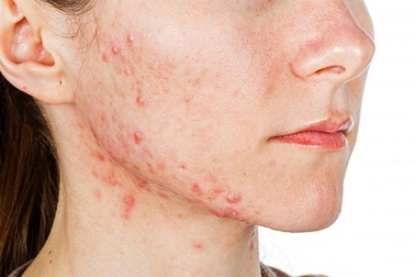 Da nổi mụn: Có phải gan đang gặp vấn đề?