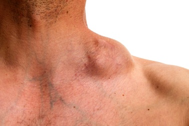 Dấu hiệu u lympho không Hodgkin