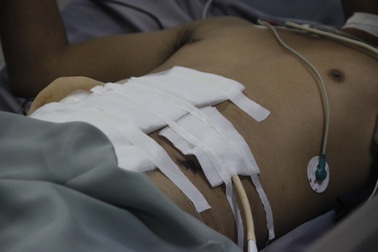 Ổ bụng ngập máu vì bị thanh sắt rơi trúng