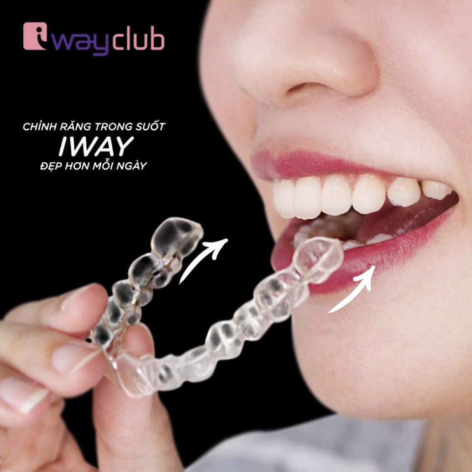 Chuyên gia iWay Club chỉ ra sai lầm về niềng răng bằng máng trong suốt - 2 Chuyên gia iWay Club chỉ ra sai lầm về niềng răng bằng máng trong suốt - 2