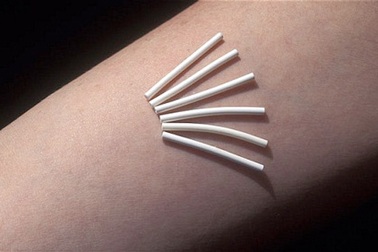 Khóc dở mếu dở vì cấy que tránh thai