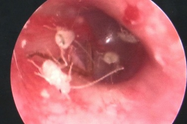 Kinh hoàng cả tổ gián trong tai thanh niên 24 tuổi