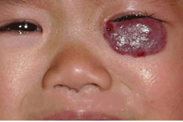 U máu và phương pháp điều trị triệt để, an toàn