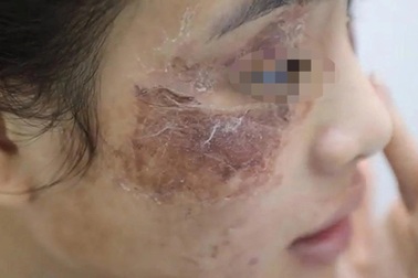 Cô gái gặp "họa" vì thoa kem mua trên mạng giá 600.000 đồng