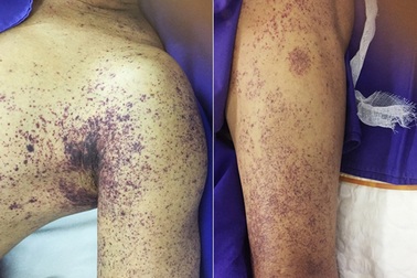 Ăn tiết canh giải đen cuối năm, 1 quý ông mất mạng