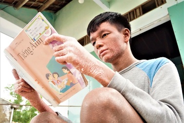 Cuộc sống của cậu bé "người rắn" từng bị xa lánh bây giờ ra sao?