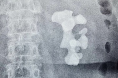 Sợ phẫu thuật, bệnh nhân bị “tảng” sỏi san hô lấp đầy thận