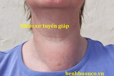 Nhân xơ tuyến giáp và những điều bạn chưa biết