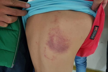 Đình chỉ cô giáo bị phụ huynh “tố” đánh học sinh lớp 2 bầm tím lưng