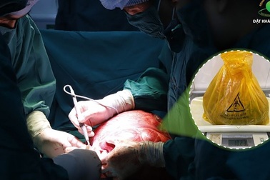 Người phụ nữ Hà Nội mang khối u xơ tử cung khổng lồ hơn 10 kg