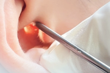 TPHCM: Cấp cứu người mẹ thủng màng nhĩ vì con trai chơi bóng trong nhà