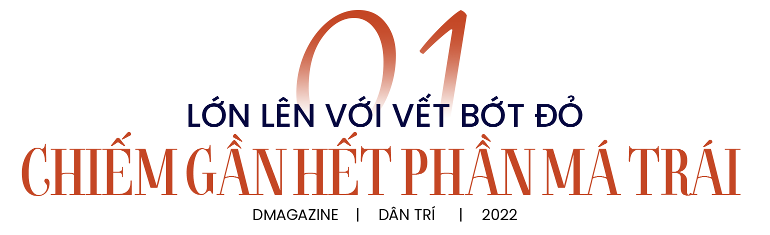 Cô giáo trẻ sống vui vẻ, tự tin với vết bớt chiếm một phần tư gương mặt - 1 Cô giáo trẻ sống vui vẻ, tự tin với vết bớt chiếm một phần tư gương mặt - 1