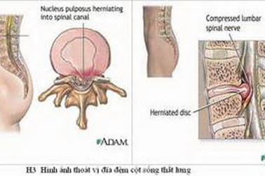 Những bệnh lý gây đau thần kinh tọa