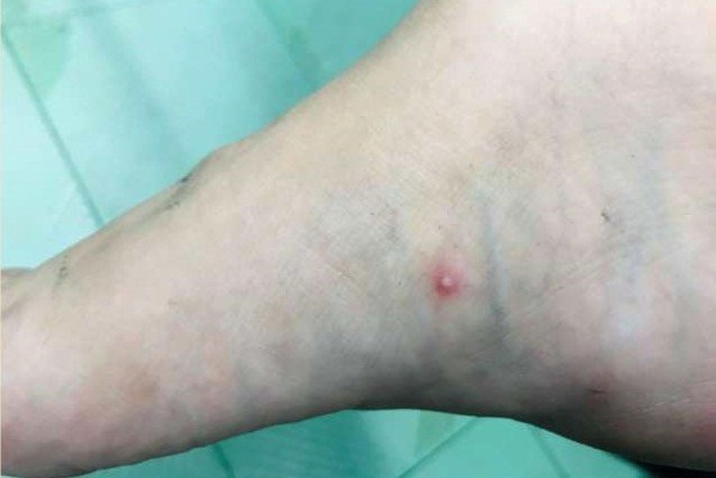 Thêm ca đậu mùa khỉ thứ 6, tiết lộ kiểu gen ca bệnh nội địa đầu tiên - 2 Thêm ca đậu mùa khỉ thứ 6, tiết lộ kiểu gen ca bệnh nội địa đầu tiên - 2
