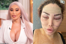 "Sao" chuyển giới Jessica Alves lộ diện sau ca thẩm mỹ lần thứ 90