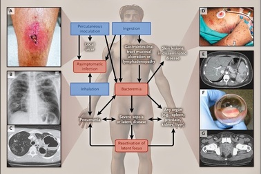 89.000 người chết trên thế giới do bệnh truyền nhiễm nguy hiểm Melioidosis