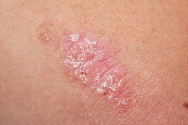 Ngứa “như điên” vì vảy nến, phải làm sao?