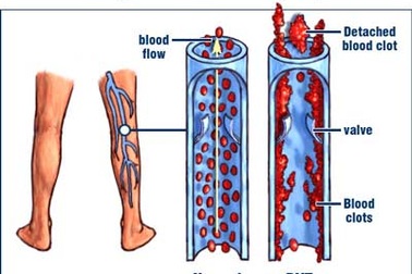 Nguy cơ rình rập trong mạch máu