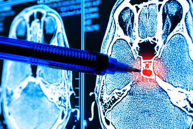 U máu thể hang tại não