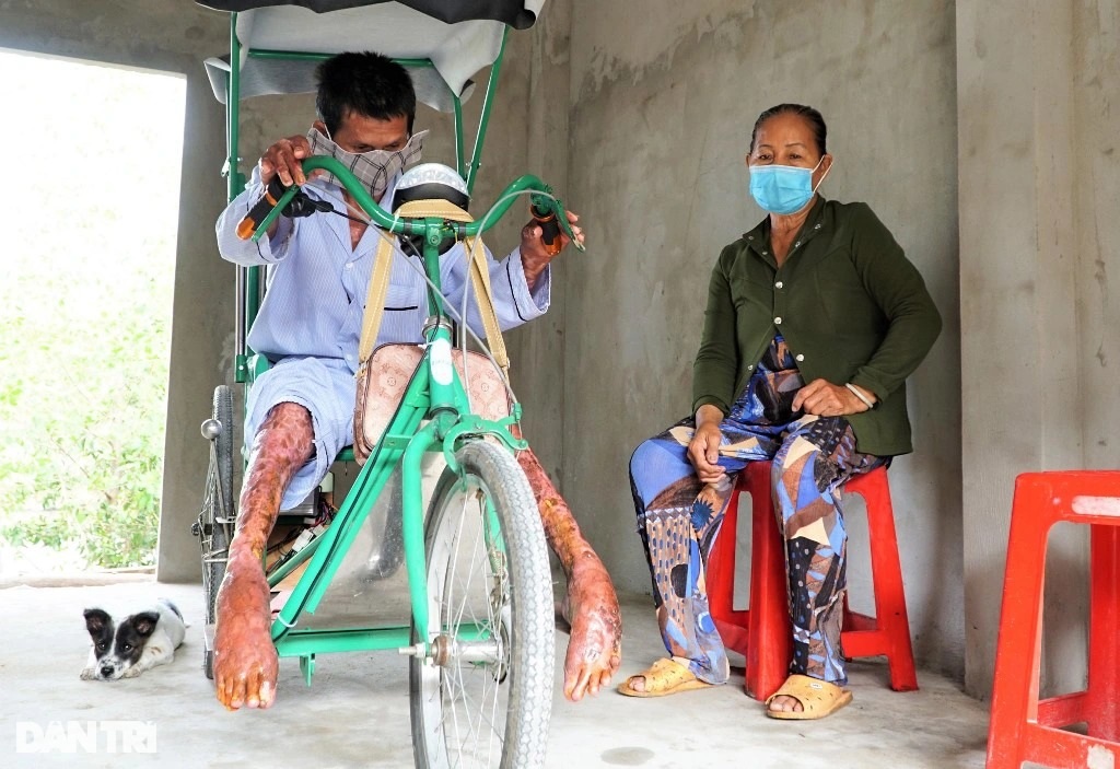 Mẹ nghèo lóc da cứu con trai bỏng nặng - 2 Mẹ nghèo lóc da cứu con trai bỏng nặng - 2