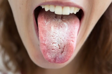 Bệnh nhân ung thư dễ bị nấm miệng: Phòng ngừa như thế nào?