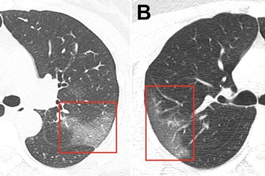 Công bố ảnh chụp lá phổi bị ảnh hưởng bởi vi rút corona mới