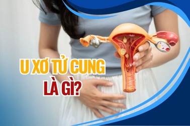 U xơ tử cung là gì, bất cứ phụ nữ nào cũng cần biết