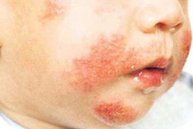 Có nên xem thường bệnh dị ứng?