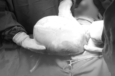 Hà Nội: Ca sinh đôi có 1 bé trai còn nằm nguyên trong túi ối