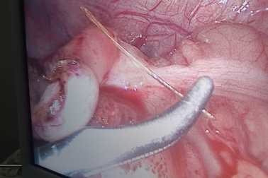 Cà Mau: Bé 13 tuổi bị xương cá đâm thủng ruột thừa hiếm gặp