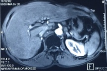 6 yếu tố làm tăng nguy cơ mắc ung thư thực quản